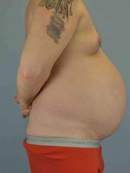 Tummy Tuck Before & After Patient #10749