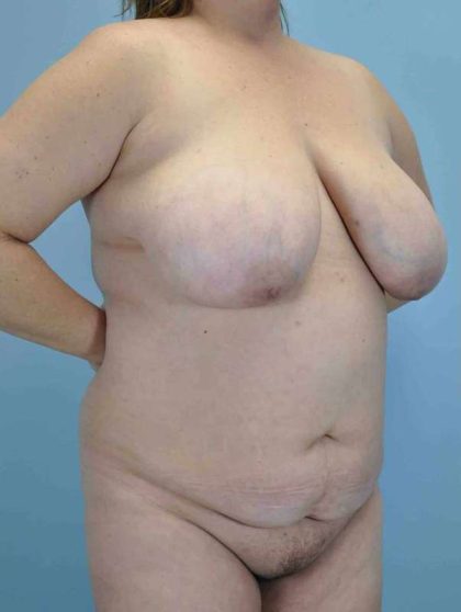 Tummy Tuck Before & After Patient #10765