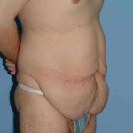 Tummy Tuck Before & After Patient #10774