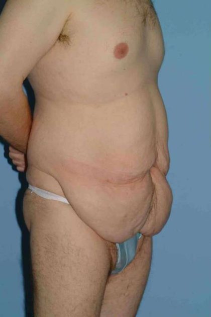 Tummy Tuck Before & After Patient #10774