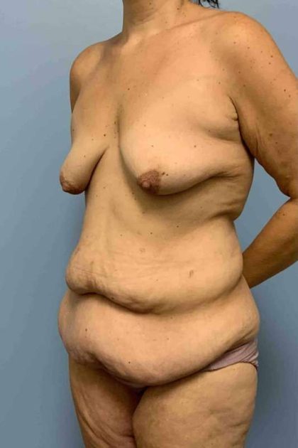 Tummy Tuck Before & After Patient #10786