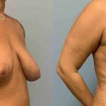 VASER Liposelection Before & After Patient #10479