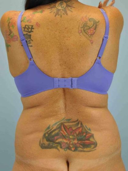 VASER Liposelection Before & After Patient #10511