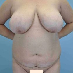 VASER Liposelection Before & After Patient #10520