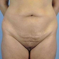 VASER Liposelection Before & After Patient #10543