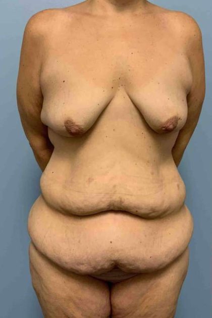 VASER Liposelection Before & After Patient #10561