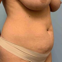 VASER Liposelection Before & After Patient #10584