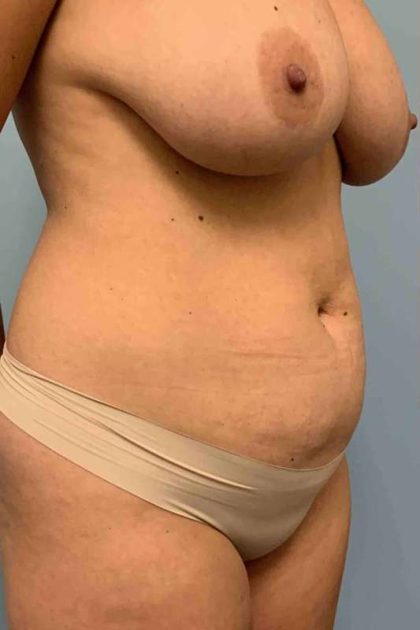 VASER Liposelection Before & After Patient #10584