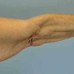 VASER Liposelection Before & After Patient #10615