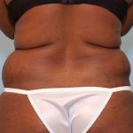 VASER Liposelection Before & After Patient #10631