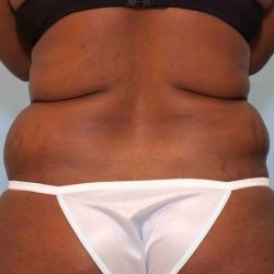 VASER Liposelection Before & After Patient #10631