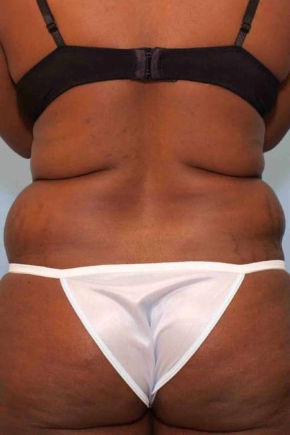 VASER Liposelection Before & After Patient #10631