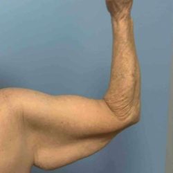 VASER Liposelection Before & After Patient #10652