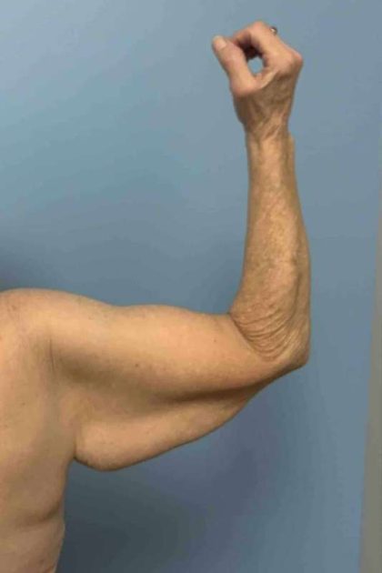 VASER Liposelection Before & After Patient #10652
