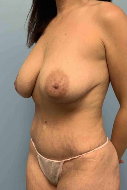 VASER Liposelection Before & After Patient #10661