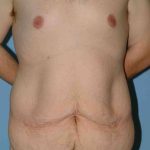 VASER Liposelection Before & After Patient #10400