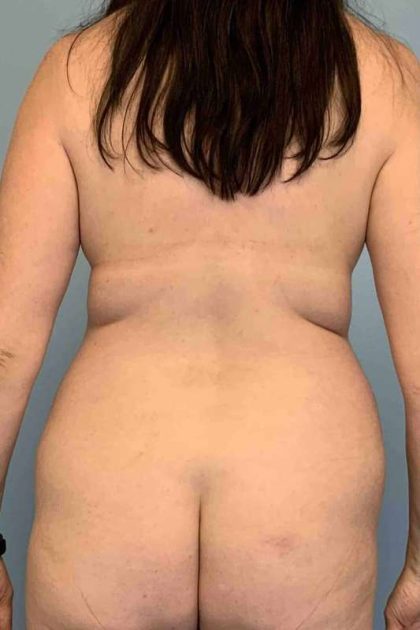 VASER Liposelection Before & After Patient #10670