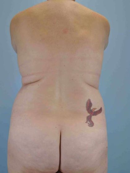 Tummy Tuck Before & After Patient #10714