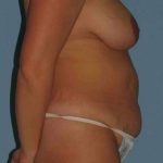 Tummy Tuck Before & After Patient #10758