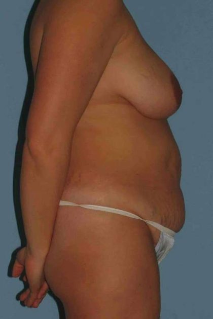 Tummy Tuck Before & After Patient #10758