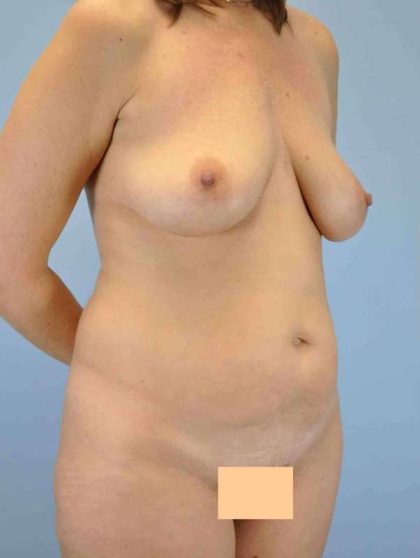 Tummy Tuck Before & After Patient #10855
