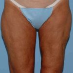 Thigh Surgery Before & After Patient #10890