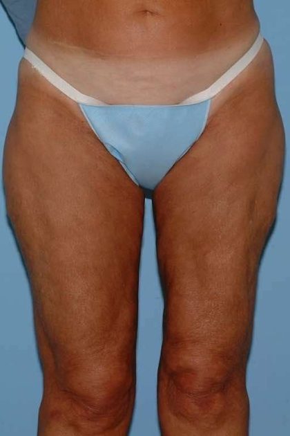 Thigh Surgery Before & After Patient #10890
