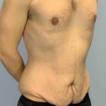 Renuvion Before & After Patient #10944