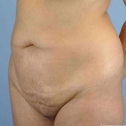 Renuvion Before & After Patient #10960