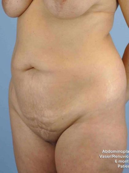 Renuvion Before & After Patient #10960