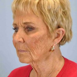 Neck Lift Before & After Patient #11069
