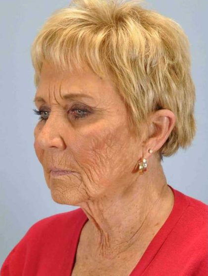 Neck Lift Before & After Patient #11069