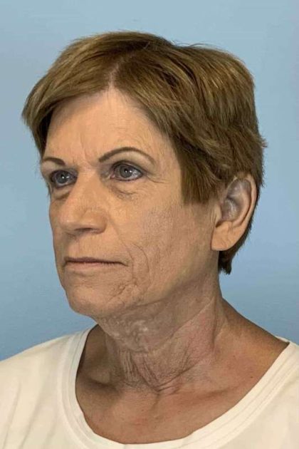 Neck Lift Before & After Patient #11092