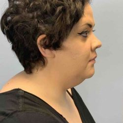 Neck Lift Before & After Patient #11120