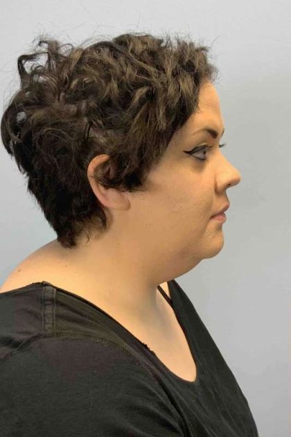 Neck Lift Before & After Patient #11120