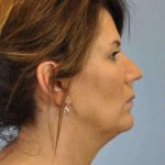 Neck Lift Before & After Patient #11145