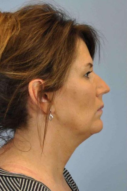 Neck Lift Before & After Patient #11145