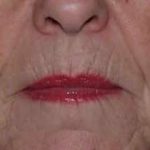 Lip Augmentation Before & After Patient #11160