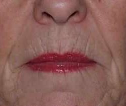 Lip Augmentation Before & After Patient #11160