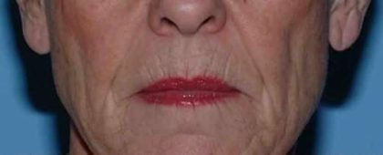 Lip Augmentation Before & After Patient #11160