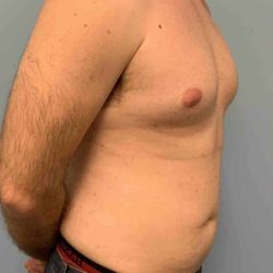 Gynecomastia Before & After Patient #11237