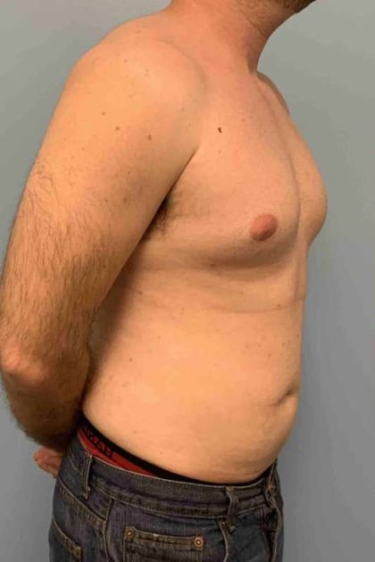 Gynecomastia Before & After Patient #11237
