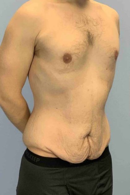 Gynecomastia Before & After Patient #11246