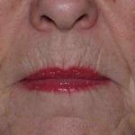 Fat Injections Before & After Patient #11321