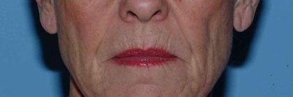 Fat Injections Before & After Patient #11321