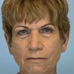 Facelift Before & After Patient #11389