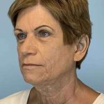 Brow Lift Before & After Patient #11779