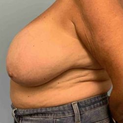 Breast Reduction Before & After Patient #11838