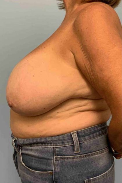 Breast Reduction Before & After Patient #11838