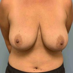 Breast Reduction Before & After Patient #11847